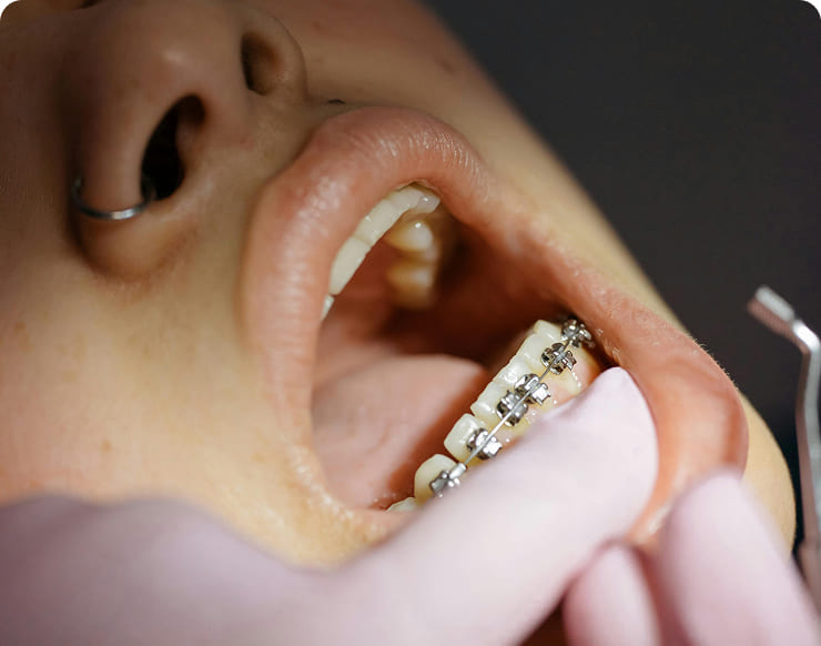Aparelhos Ortodônticos
