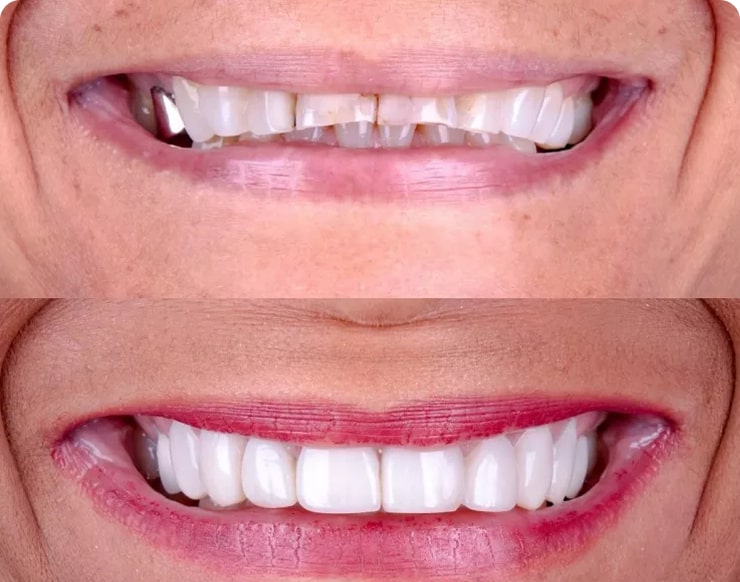 Foto de antes e depois de limpeza e lentes