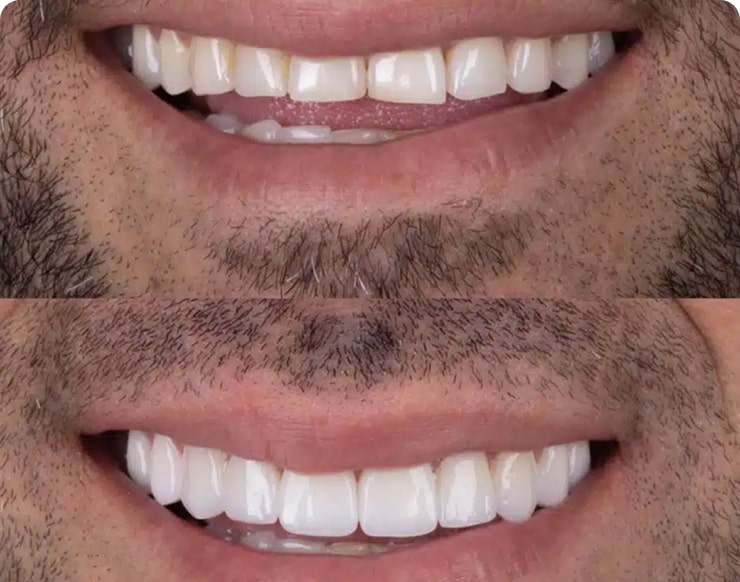 Foto de antes e depois de prótese dental móvel