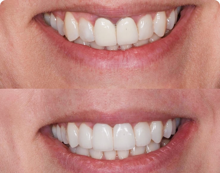 Foto de antes e depois de clareamento