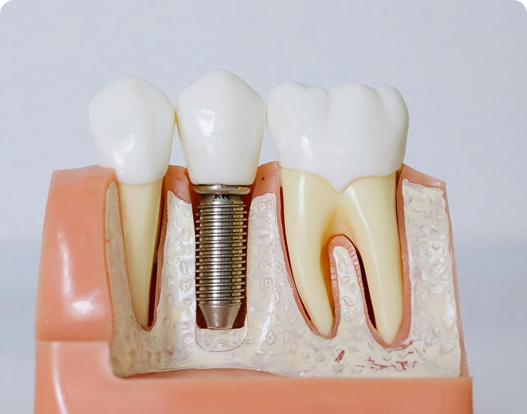 Implantes Dentários