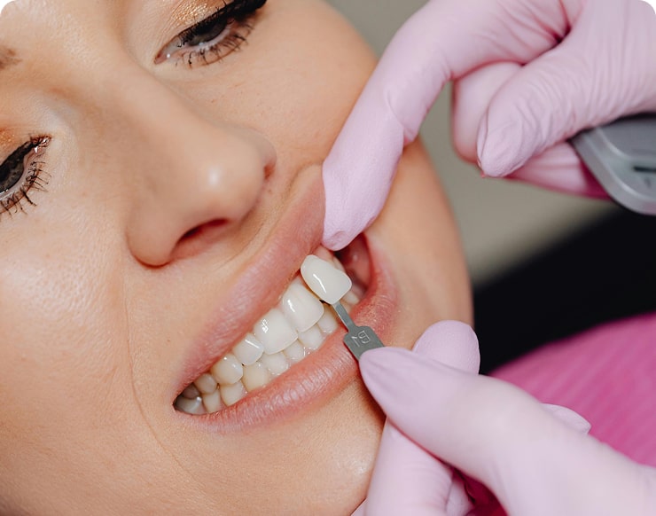 Lentes de Contato Dentais